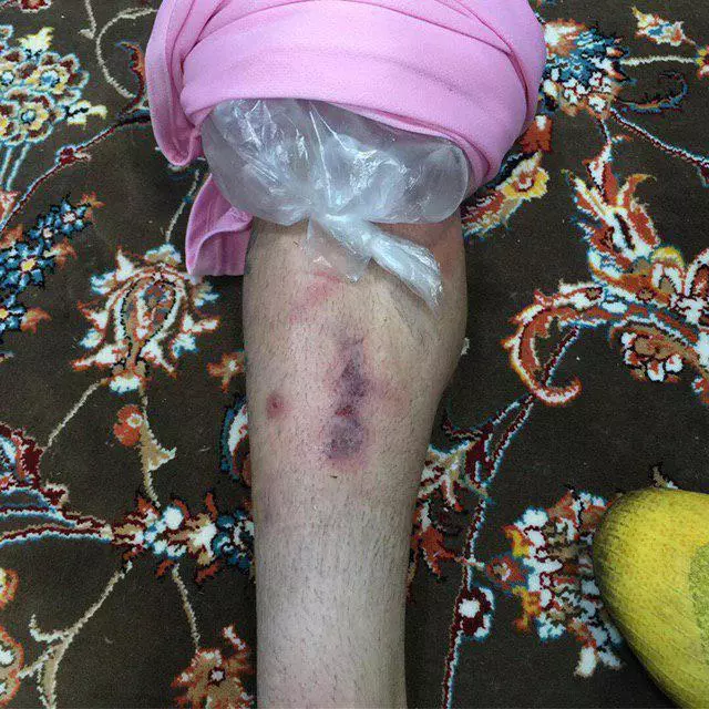 تصویری از ساق پای محمدرضا خلعتبری. او در دقایق پایانی بازی ذوب‎آهن و نساجی شدیدا مصدوم شد.